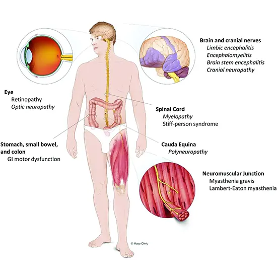 paraneoplastic syndromes